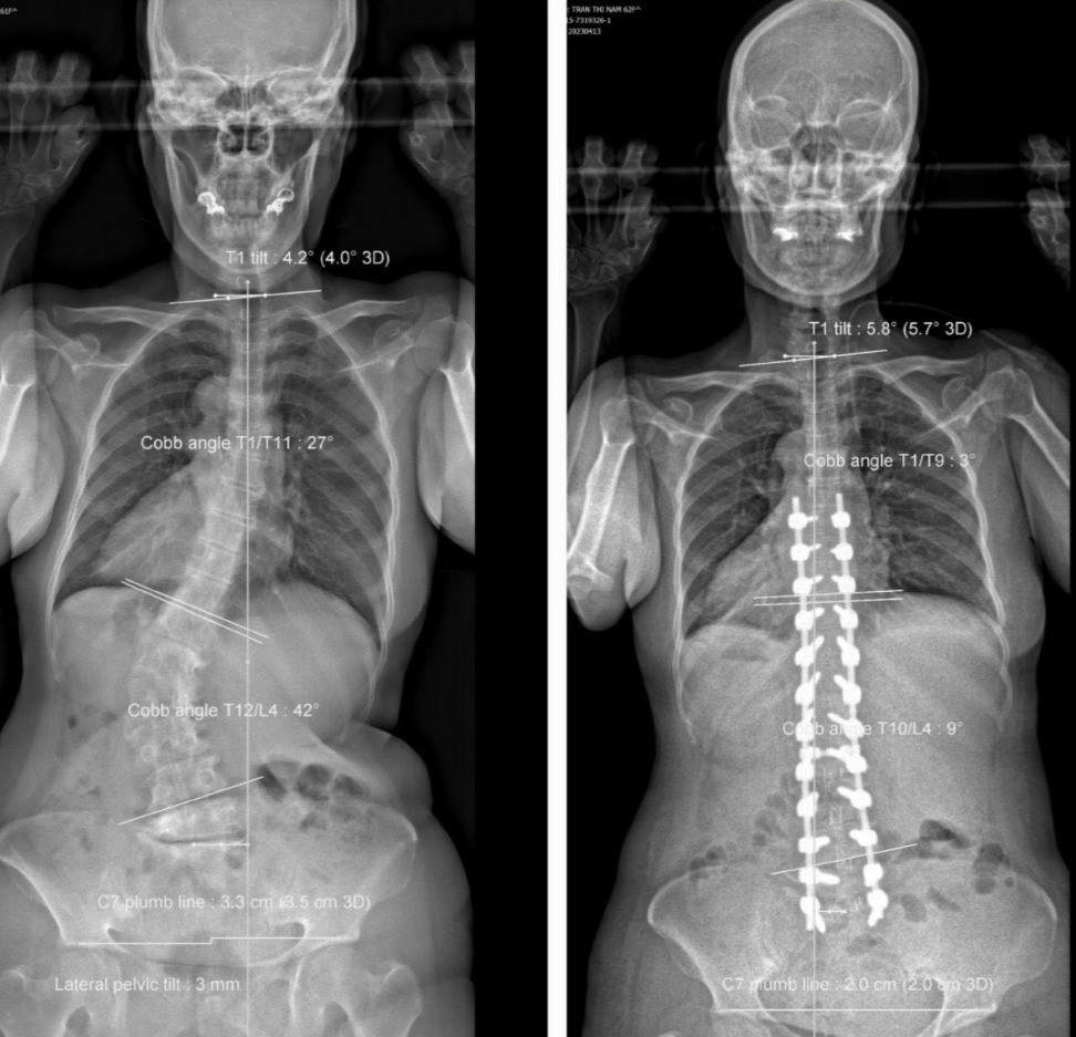 重度の変形性脊椎症の女性患者、手術後に身長が8cmアップ [三面] - VIETJOベトナムニュース